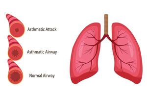 illustration of asthmatic airway, normal airway, asthmatic airway, asthmatic attack airway. medical illustration. vector