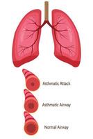 asthmatic airway, normal airway, asthmatic airway, asthmatic attack airway. medical illustration. eps 10 vector