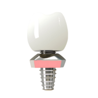 Dental Implant Crown Abutment and Porcelain Restoration High Resolution 3D Render png