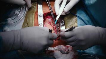 Team of two doctors men surgeons processing surgical operation using endoscopic medical instruments in sterile operating room hospital emergency surgery procedure with anesthesia saving patient life video