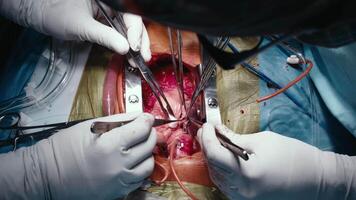 Cardiac surgery. Heart transplantation. Open heart surgery. Surgical instruments. Surgeon at work in the hospital. Open chest. Medical tools video