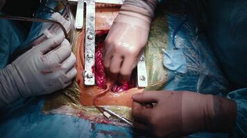 Surgeons Perform Heart Surgery Using High Technology. Difficult Heart Transplant Operation. A team of women and men surgeons doing complex heart surgery, cardiovascular surgery, modern medicine video