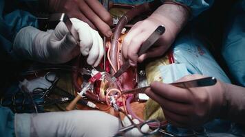 A surgeons team in uniform performs an operation on a patient at a cardiac surgery clinic. Modern medicine, a professional team of surgeons, health video