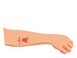 Minimalist illustration of an allergic reaction on a human arm. Red rash and irritation depict symptoms of skin allergies, dermatitis, or allergic reactions vector