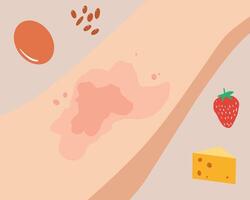 illustration of an allergic reaction on the skin, showing red rashes and irritation. One version includes common allergenic foods like nuts, strawberries, cheese, and eggs. Useful for medical, vector