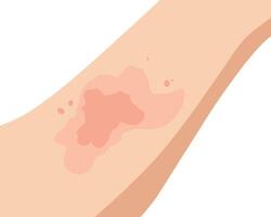 illustration of an allergic reaction on the skin, showing red rashes and irritation vector