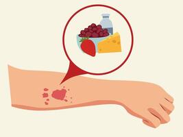 Illustration of an allergic reaction on a human arm caused by food. Red rash and irritation indicate sensitivity to certain ingredients like dairy, fruits, and nuts vector