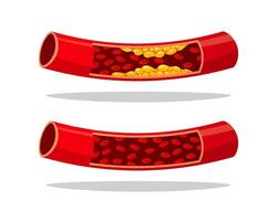Types of cholesterol. Artery with cholesterol plaque. Illustration cholesterol. vector