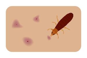 Flea causing skin irritation and red spots, medical illustration representing a common health issue vector