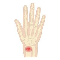 Hand fracture painful dislocation of the radius. Fall on an outstretched hand. vector