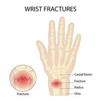 Anatomy of the hand radial dislocation aseptic necrosis displacement fracture painful fall vector