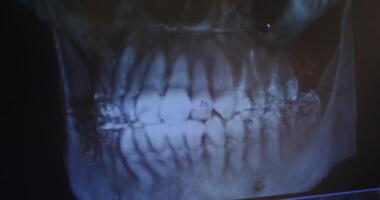 X-ray image of the patient's jaw on the doctor's monitor, close-up. Orthopantomography device for teeth, MRI, in 4k, red komodo video