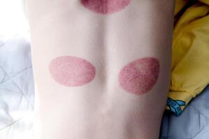 Red spots on the back of a little boy after cupping procedures, rear view. High quality photo