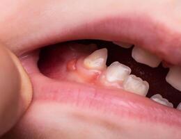 A bump is a tumor on the tooth gum in a child. Periodontitis in children due to a tooth with pulpitis. Close-up photo