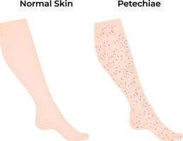 Normal Skin Petechiae Science Design Illustration Diagram vector