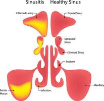 Sinusitis Healthy Sinus Science Design Illustration Diagram vector