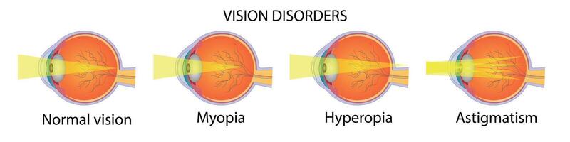Visual impairment diagram with names and eyeball structure illustration. vector