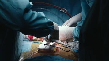 Side view of Surgical team making operation in sterile medical room. Assistants and anesthesiologist perform a complex operation on a patient under general anesthesia. video