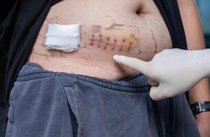 Cropped shot view of someone pointing to patient belly after Appendectomy surgery. photo
