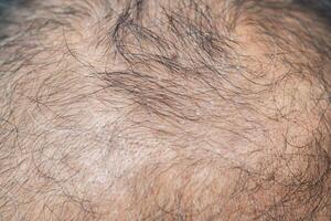 Cropped shot view of bald spot on Asian men's head with dandruff problem. Dandruff is a common condition that causes the skin on the scalp to flake. photo