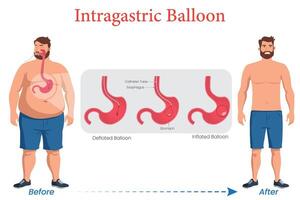 Intragastric Balloon Diagram Illustration Showing Weight Loss in an Obese Man After Use vector