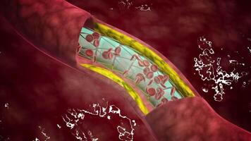 Cross-section of stent deployment in artery. video