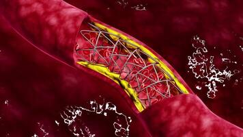 Artery cross-section with blood flow, fat plaque and stent deployment. video