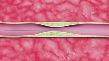 Stent deployment in artery. video