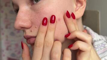 Close up photo of acne prone skin, young woman squeezing her pimple, Removing pimple from neck. Acne pus. squeezing pimple macro video