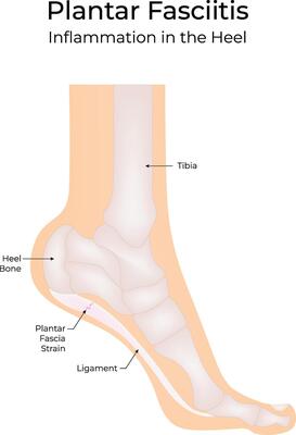 Plantar Fasciitis Science Design Illustration Diagram