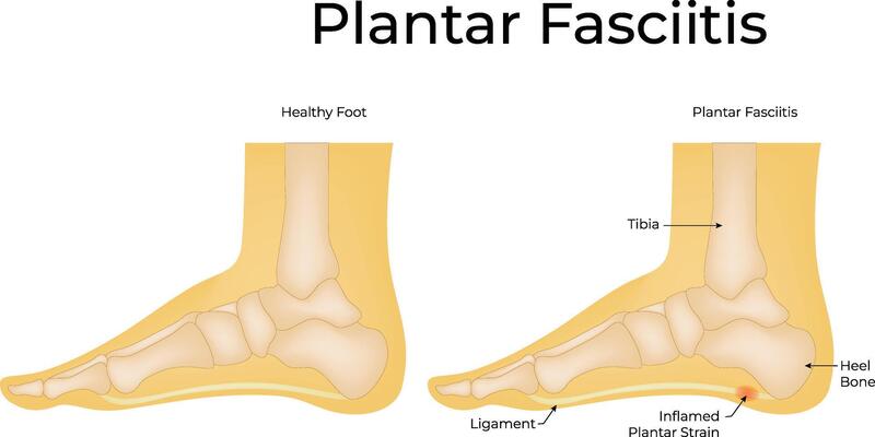 Healthy Foot and Plantar Fasciitis Foot Science Design Illustration Diagram