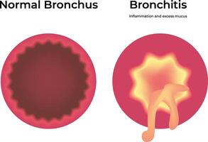 Normal Bronchus Bronchitis Science Design Illustration Diagram vector