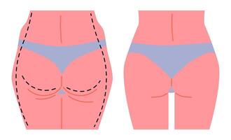 Liposuction Surgery Before and After Comparison. vector