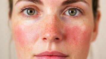 Close-up of a woman's face with red cheeks and freckles. Her eyes are green, and she has a fair complexion. Skin issue displayed. photo