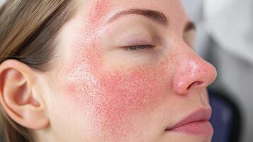 Woman's face with redness after a skin treatment showing before and after effects, results and cosmetic procedures. photo