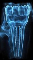 3d ilustración de un dental implante con radiografía efecto en un negro antecedentes foto