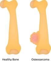 Healthy Bone Osteosarcoma Science Design Illustration Diagram vector