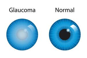 Glaucoma surgery concept. Procedures to reduce intraocular pressure to prevent vision loss. Human eye anatomy poster vector