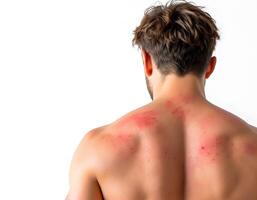 Man's Back with Sunburn or Rash Medical Image photo
