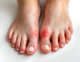 Close up Image of Feet with Red, Inflamed Joints, Possible Gout or Allergic Reaction. photo