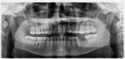 Detailed panoramic dental X-ray showing teeth structure. photo