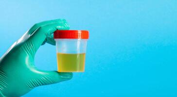 Urine analysis in the hands of a doctor laboratory assistant on a blue background. Urine tests for protein, infections and mucus. Pyelonephritis and urethritis in urology. Copy space for text photo