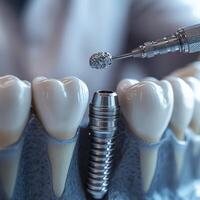 Close-Up of Dentist Placing Titanium Implant in Patient's Jaw photo