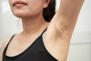 Asian woman have problem black armpit beauty photo
