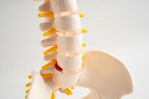 Lumbar spine displaced herniated disc fragment, spinal nerve and bone. Model for treatment photo