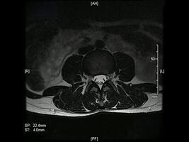 Magnetic resonance imaging of the lumbar spine axial projection animation video