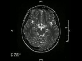 Magnetic resonance imaging of the brain axial projection animation video
