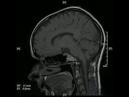 Magnetic resonance imaging of the brain sagittal projection animation video