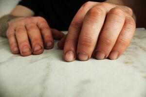 Male hands with broken nails close-up. Hand skin photo