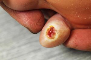 Close-up wound on the little toe. Finger wounds photo